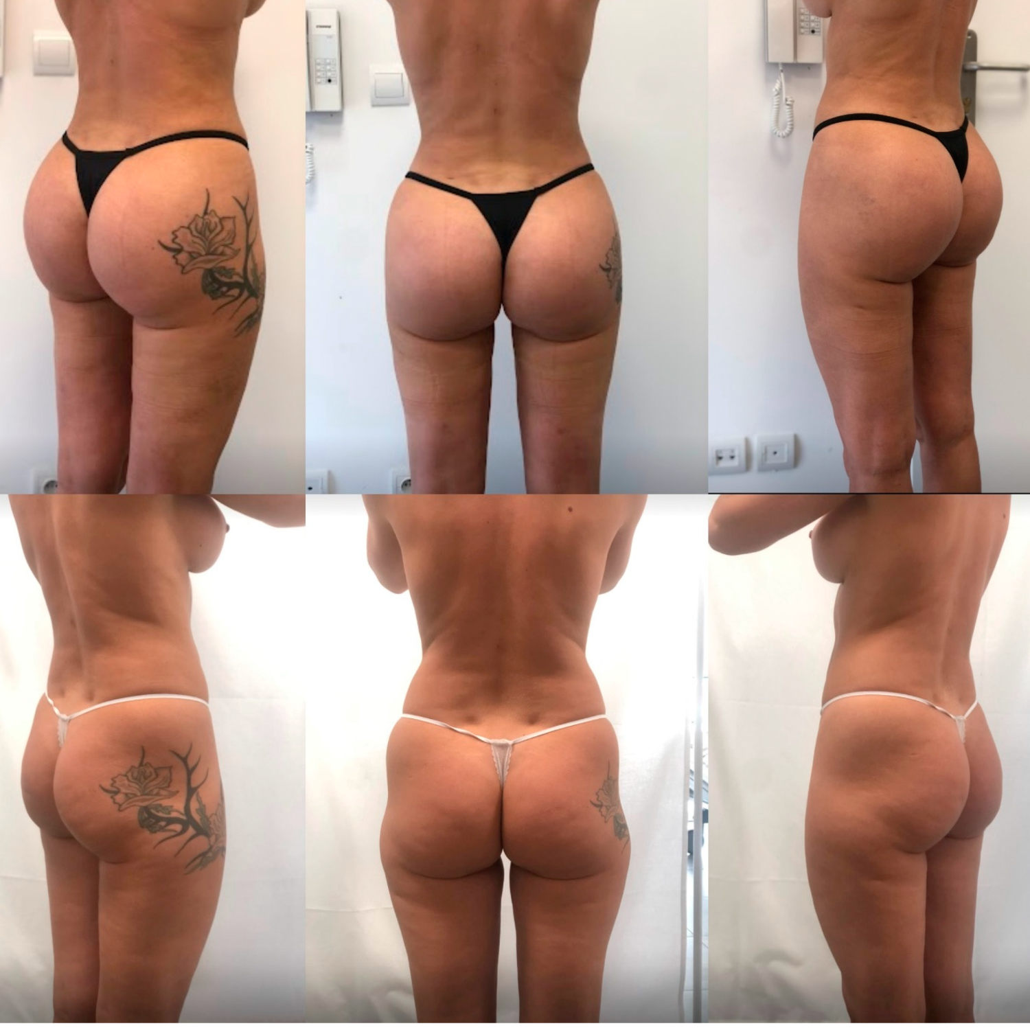 1000CC PMMA BUTTOCK INJECTIONS thumbnail 5