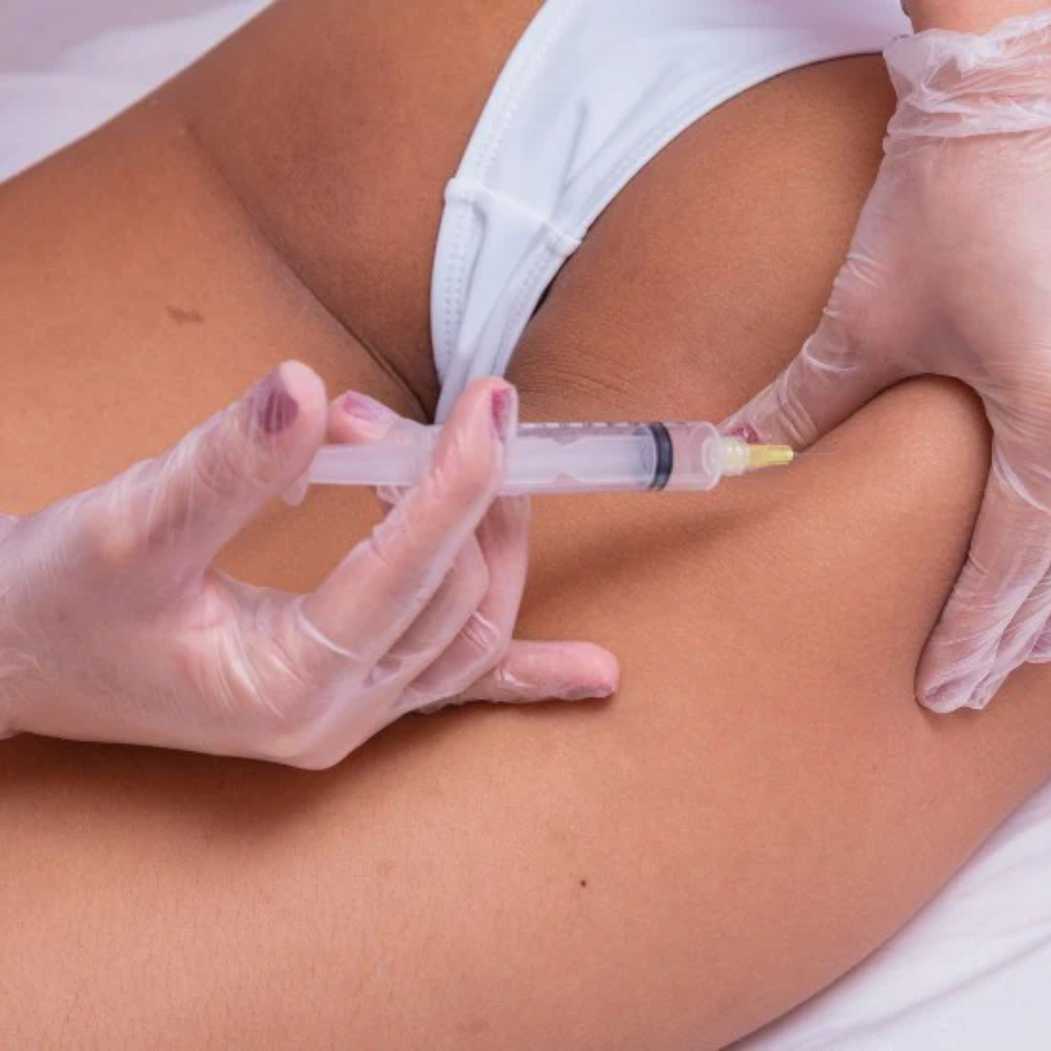 1000CC PMMA BUTTOCK INJECTIONS thumbnail 6